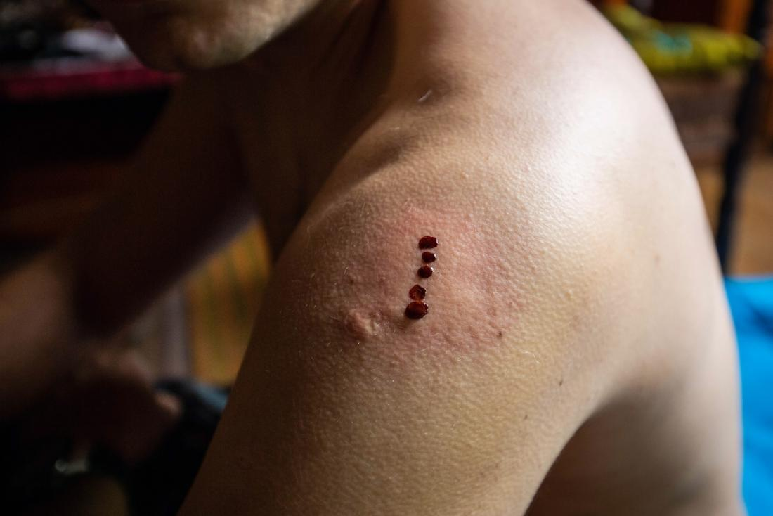 . These markings appear consistent with those created during a Kambo ceremony, an Amazonian ritual where a frog's poison is applied to burns on the skin.